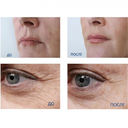 Quanis Dermafiller патчи с растворимыми микроиглами из гиалуроновой кислоты и коллагена